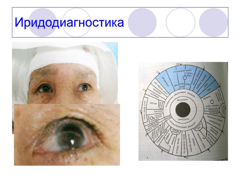 Иридодиагностика